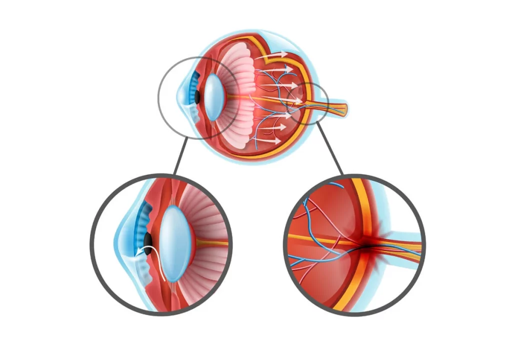Glokom (Göz Tansiyonu)